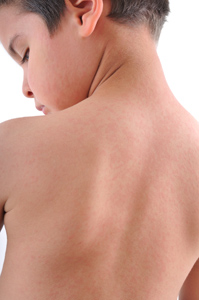 Dermatitis atpica